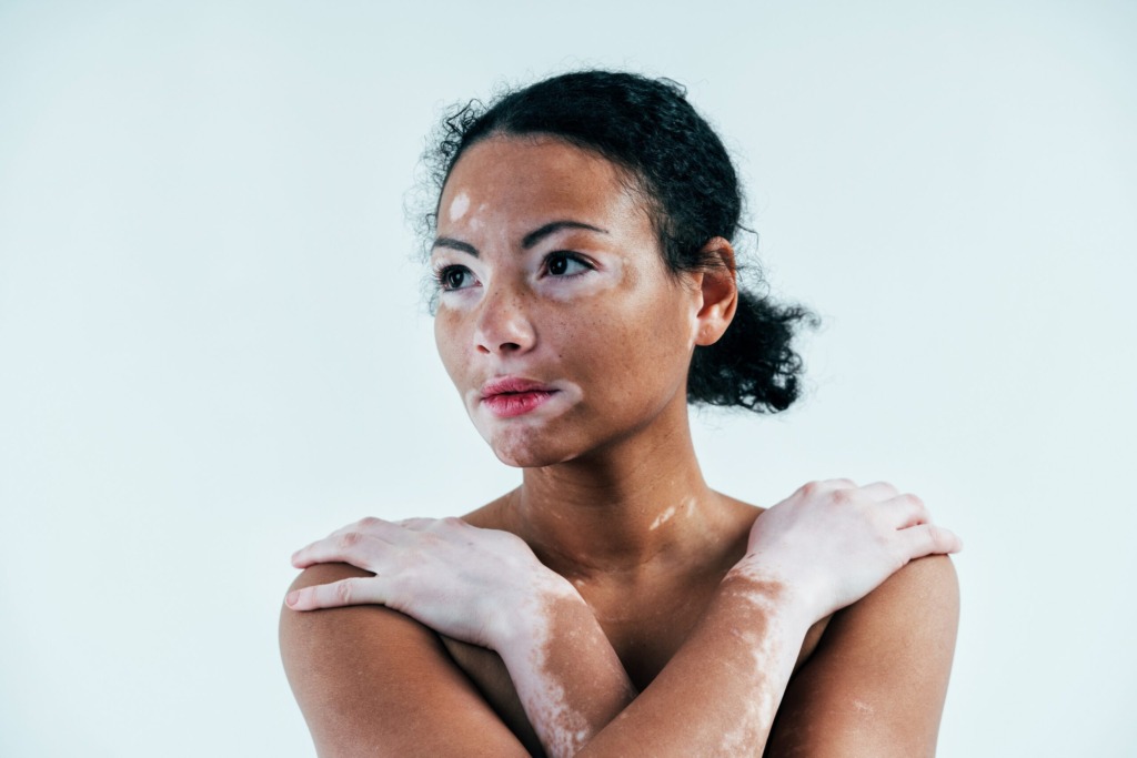 Vitiligo é Genético?