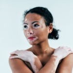 Vitiligo é Genético?